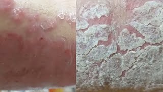 EXTREME REGENERATION 1 WEEK AFTER FULL CLEANING Psoriasis [upl. by Alvina]