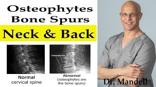 Do Bone SpursOsteophytes in Neck amp Back Go Away  Dr Alan Mandell DC [upl. by Eadwina]