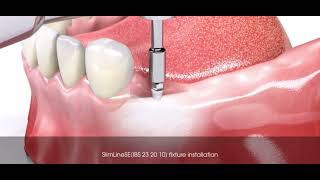 Prothèse amovible CLIPSÉ sur implant bouton pression [upl. by Uol]