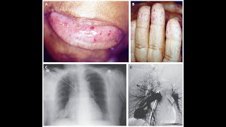 Hereditäre hämorrhagische Telangiektasie [upl. by Tillo201]