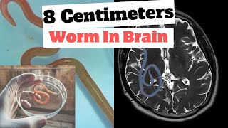 Australia womans brain invaded by parasitic worm  health news facts [upl. by Max936]