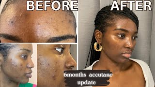 GETTING RID OF ACNE amp HYPERPIGMENTATION  6 MONTHS ACCUTANE UPDATE  ACCUTANE JOURNEY [upl. by Alvira]