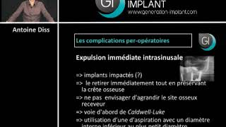 Implants dentaires  Les complications [upl. by Xantha]