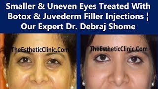 Asymmetrical Eyes Treatment  Botox amp Juvederm Filler Injection  The Esthetic Clinics India [upl. by Desirae228]