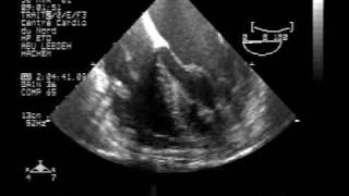 echocardiogram endocarditisTEEvegetation on the pacemaker lead [upl. by Edelson]