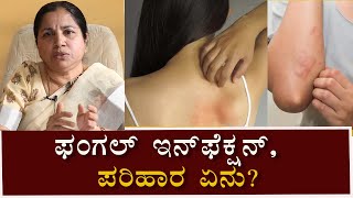 Fungal infections Symptoms amp Treatment  ಫಂಗಲ್ ಇನ್‌ಫೆಕ್ಷನ್  ಲಕ್ಷಣಗಳು amp ಕಾರಣಗಳು  Vijay Karnataka [upl. by Mcgannon235]