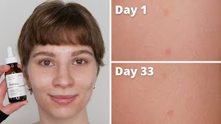 The Ordinary Ascorbic Acid 8  Alpha Arbutin 2 Dark Spots Results  1 Month with Pictures [upl. by Lavona976]