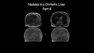 Nodules in a Cirrhotic Liver  Part 8 radiology radiologist cirrhosis liverdisease liverhealth [upl. by Aubry]