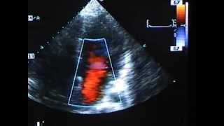 Severe Mitral Valve Prolapse [upl. by Radec]