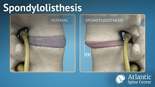 Spondylolisthesis [upl. by Polish286]