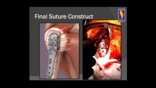 Occupational therapy  distal humerus fracture [upl. by Sidoon]