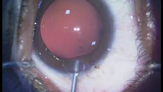 Phakic intraocular lens pIOL in cases of high myopia  Supplementary video ID 270690 [upl. by Airotnes]