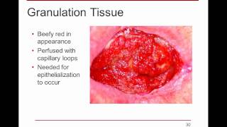 WoundRounds Free Webinar  PUSH Tool for Monitoring Pressure Ulcer Healing A Practical Guide [upl. by Rehc]