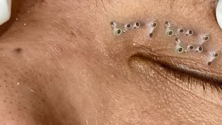 Big Cystic Acne Blackheads Extraction Blackheads amp Milia Whiteheads Removal Pimple Popping 092 [upl. by Valora]