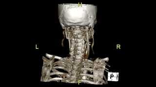 CT Angiogram Bruce Frankel MUSC CharlestonSC [upl. by Refinneg]