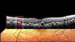 SPECTRALIS  Simultaneous Imaging [upl. by Margeaux752]