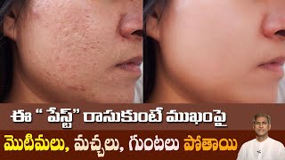 Get Rid Of Dark Spots amp Pigmentation  Mens Skin Care  BeYourBest Grooming by SanKalra [upl. by Tekcirc442]