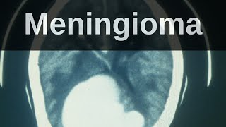 What is a Meningioma Pathology mini tutorial [upl. by Ynatirb]