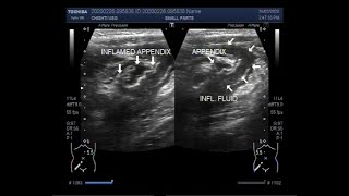 Ultrasound Video showing a leaked or ruptured Appendix [upl. by Cyrilla975]