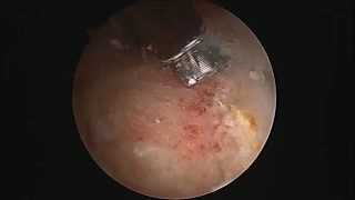 Hip Labral Tear debridement and Repair [upl. by Vedette]