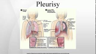 Pleurisy [upl. by Ludwigg]