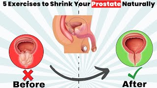 5 Exercises to Shrink Your Prostate Naturally  Enlarged Prostate Treatment  FITNESS SX [upl. by Rhona]