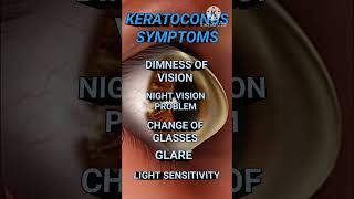 KERATOCONUS  TREATMENT keratoconus KERATOCONUSTREATMENT [upl. by Dom243]