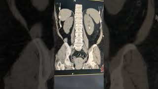 CT KUB with stone protocol in radiology medical NCCT [upl. by Naugal]