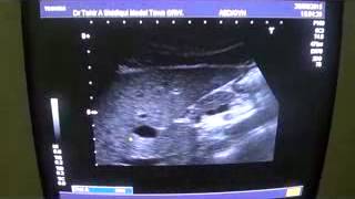 SIMPLE CYST CAUDATE LOBE of LIVER  segment 1 [upl. by Arlen]