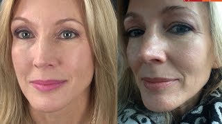 My Experience With Botox amp Filler Juvederm [upl. by Paddie]