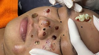 blackheads new 2023  popping pimple today  blackheads and whiteheads removal [upl. by Granese]