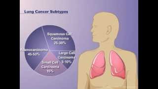 The Pathophysiology of Nonsmall Cell Lung Cancer [upl. by Standley]