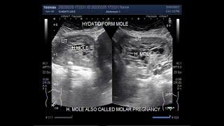 Hydatidiform Mole also called Molar Pregnancy [upl. by Eneli]