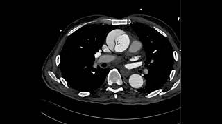 Dissecção da aorta tipo A [upl. by Xel]