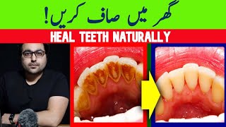 Dr ZeeNatural Remedy for dental Plaque Cavities and Gingivitis [upl. by Hanaj]