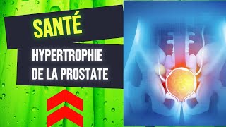 LHypertrophie Bénigne de la Prostate [upl. by Nilauqcaj288]