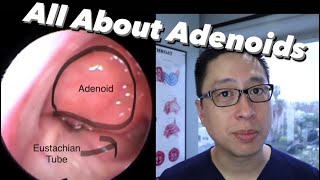 Adenoids and Adenoidectomy what are they when do we remove them what is the surgery like [upl. by Ahsiled31]