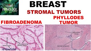 Diseases of Breast Part 3 Fibroadenoma amp Phyllodes tumor [upl. by Corabella]