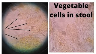 Vegetable cell in Stool  Stool examination microscopic medicallabtechnologysajal6903 [upl. by Reginald]