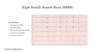 Right Bundle Branch Block RBBB  Features Electrophysiology Causes amp Differential Diagnosis [upl. by Thinia]