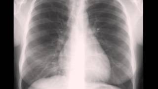 Right Middle Lobe Atelectasis [upl. by Anits]