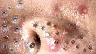 blackheads new 2023  popping pimple today  blackheads and whiteheads removal [upl. by Maisel]