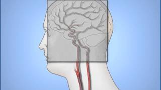 Diagnostic Cerebral Angiography [upl. by Aokek]