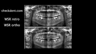 Wurzelspitzenresektion versus Endodontie [upl. by Arimahs]