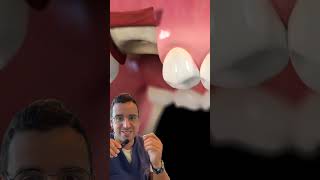 Chirurgie IMPLANT dentaire 3D  explication implantologie [upl. by Anayk]