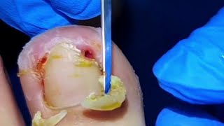 Patient Screams When Huge Ingrown Toenails Get Pulled By Pedicurist [upl. by Evets]