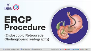 What is ERCP Test and How it is done  Department of Gastroenterology  Pace Hospitals [upl. by Gilder]