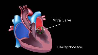 Physiology of rheumatic heart disease [upl. by White]