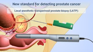 Transperineal Prostate Biopsies Under Local Anesthesia [upl. by Baptiste845]