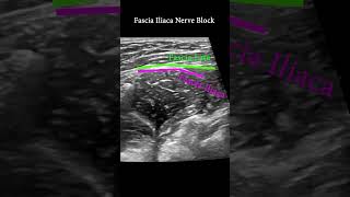 Fascia Iliaca Plane Block ultrasound nerveblock anatomy [upl. by Ambrosio]